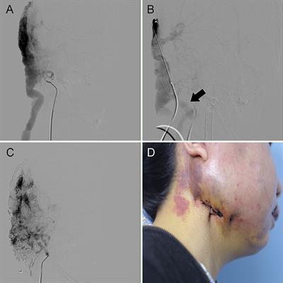 Management of high-output cardiac failure caused by head and neck AVMs: Percutaneous suture-assisted ethanol and coil embolotherapy